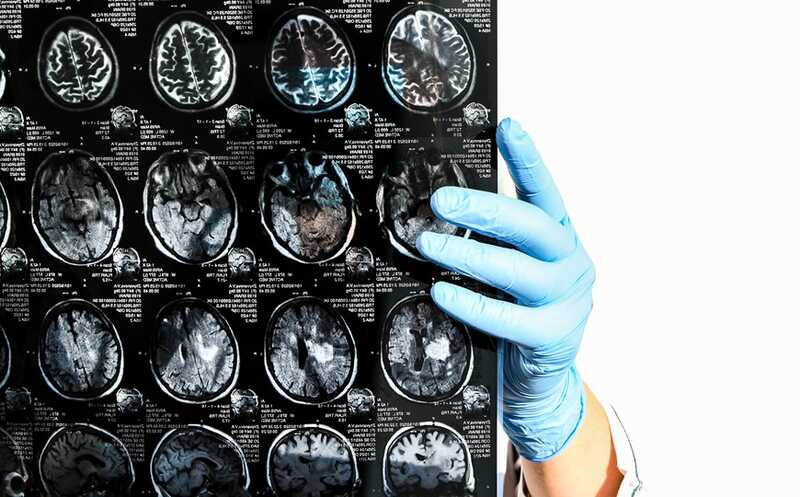 Тау-белок можно использовать для прогнозирования последствий инсульта