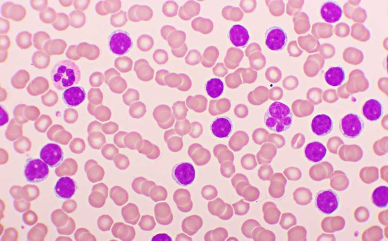 Антагонист рецептора соматолиберина преодолевает устойчивость рака крови к доксорубицину