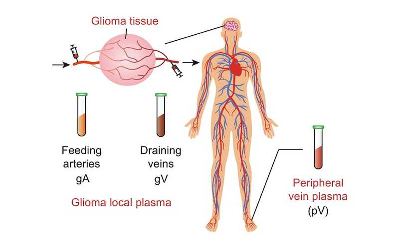 Пространственная протеомика обнаружила потенциальный маркер глиомы в крови