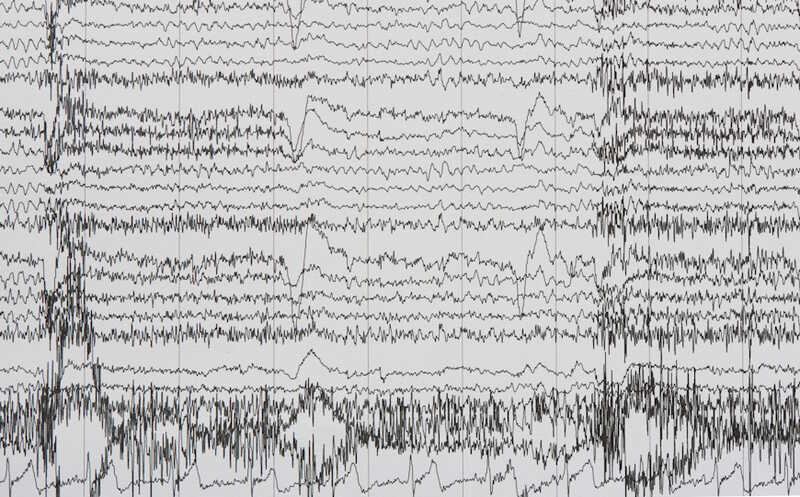 Польза кетогенной диеты при эпилепсии может быть связана с изменением транскриптома гиппокампа