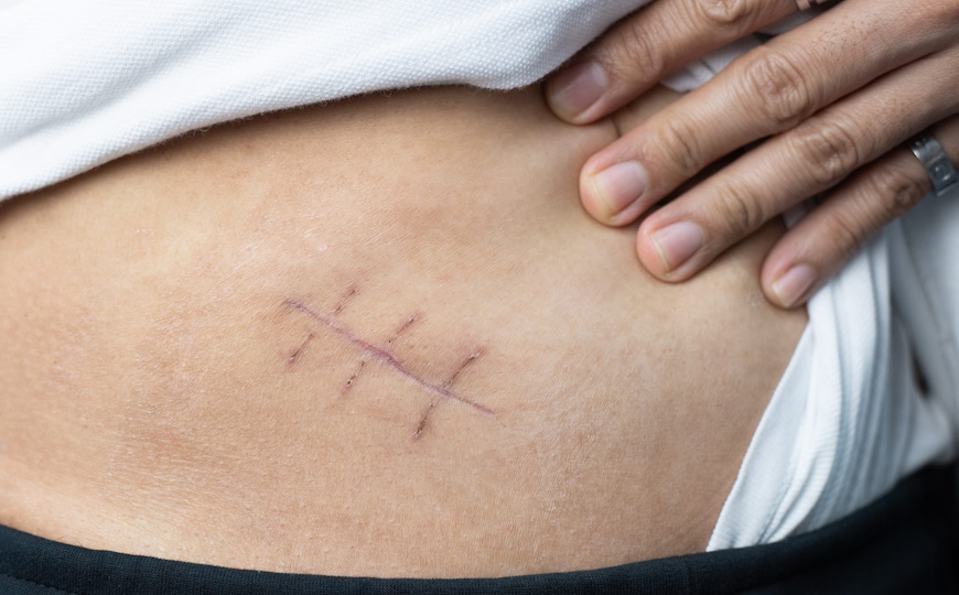 Регенерации кожи препятствует активный рост нервов вокруг раны