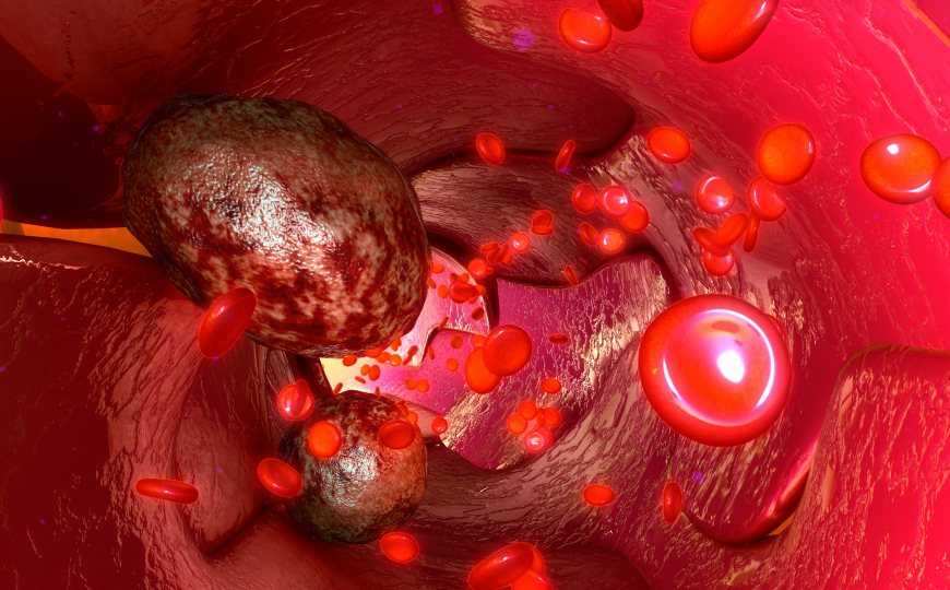 Восстановление кровотока в раковой опухоли поможет ее убить